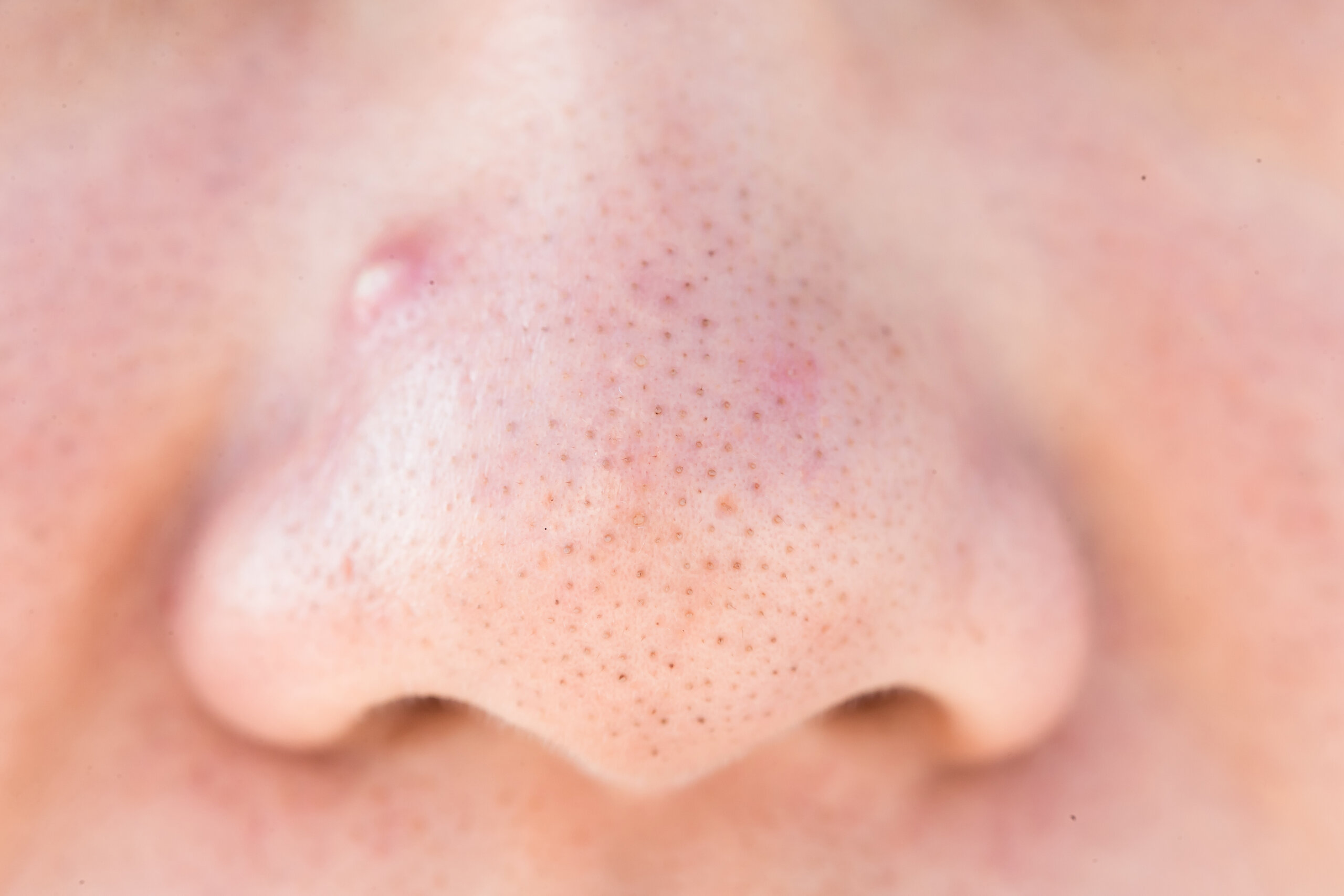NOSE　PORES